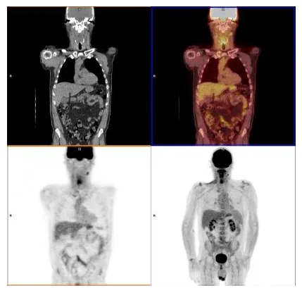 Non -Invasive Ways to Detect Cancer 1 018490ad fi png