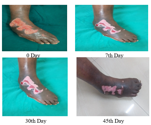 Effect of Unani Formulation in the Management of Non-Healing Ulcer – A Case Report 1 0244e29e fi
