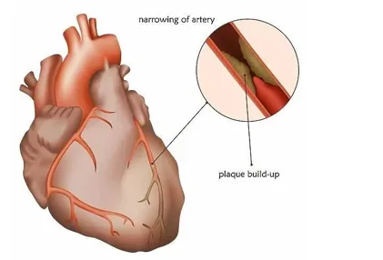 Study of Lipid Profile and Its Correlation with Coronary Angiogram Finding in a Tertiary Care Hospital in an Urban Setting 1 22b7e887 ll png