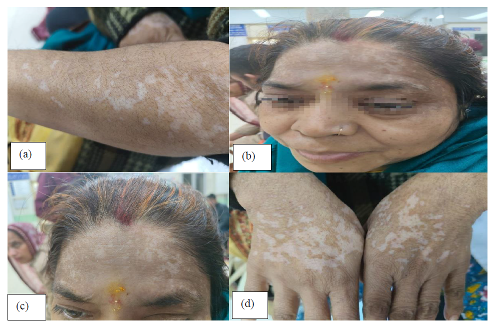 A Case Study on the Efficacy of Sanshamana Chikitsa in Vitiligo (Shwitra) 1 437e7639 fi
