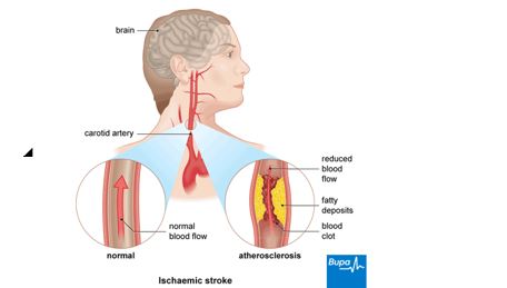 Revealing the Hemodynamic Orchestra: Contrasting Analysis of Blood Flow Patterns in a Bifurcated Carotid Artery 1 80c35e55 feature image