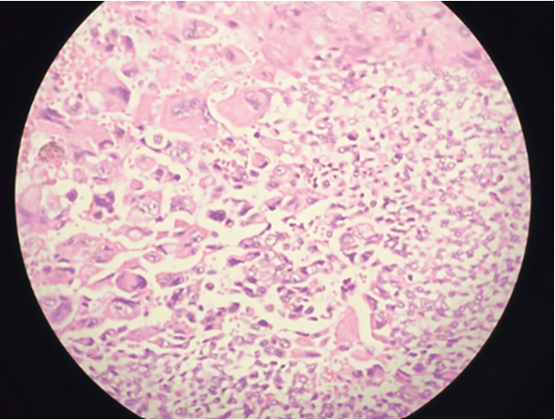 Hidradenocarcinoma: A Rare Skin Disease 1 80c51476 f