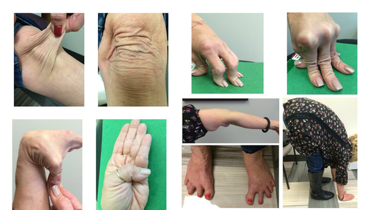 Stretching Boundaries: A Comprehensive Review of Ehlers-Danlos Syndrome and its Subtypes 1 8aaae6d1 fd