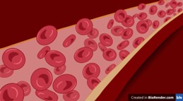 The Curious Case of the Sphered Blood Cells: Unveiling Hereditary Spherocytosis. 1 8d594ae7 picture1