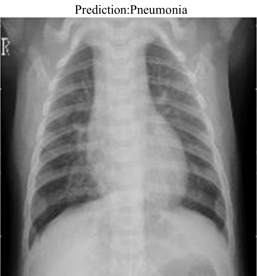 Detection of Pneumonia in COVID-19 Patients Using X-ray Images 1 dab0dd56 pnuemonia2