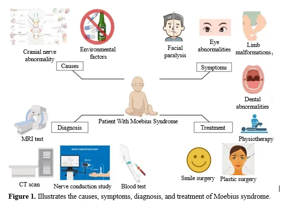 Comprehensive Review of Moebius Syndrome: Clinical Landscape, Etiology, and Therapeutic Challenges 1 f3ac74ed capture 21 png