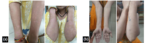 A Case Study on Ayurvedic Management of Psoriasis. 1 f7ffd745 fe