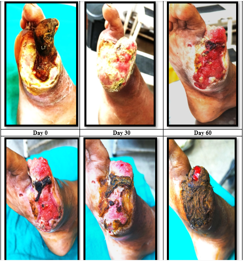Diabetic Foot Ulcer Treated successfully with Unani Formulation (Sibr Zard, Amba Haldi, Mur Maki, and Gulnar) –A Case study 1 fe7ae381 capture 343