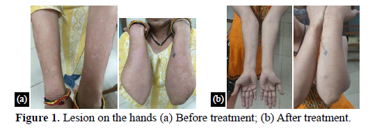 A Case Study on Ayurvedic Management of Psoriasis. 2 figures