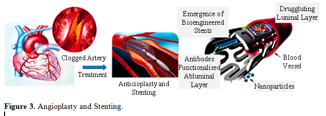 Overview of Recent Advancement of Nano Stent in Pharmaceutical Application 4 figures