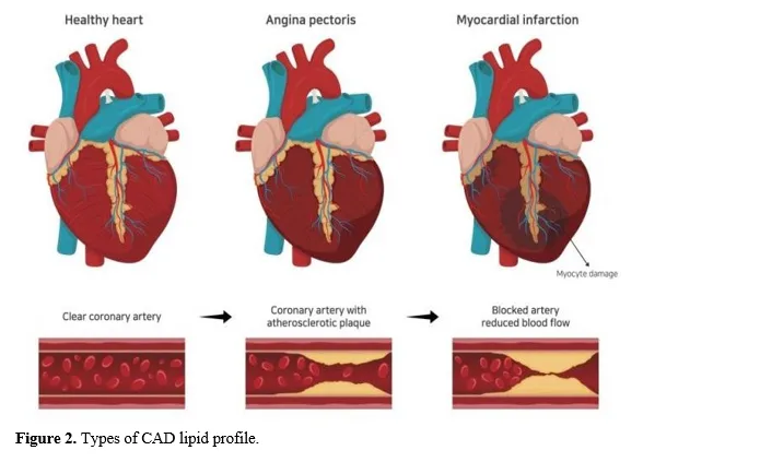 Study of Lipid Profile and Its Correlation with Coronary Angiogram Finding in a Tertiary Care Hospital in an Urban Setting 3 figures