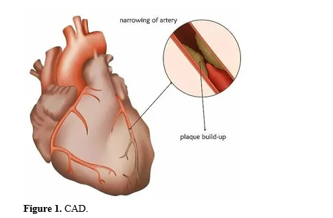Study of Lipid Profile and Its Correlation with Coronary Angiogram Finding in a Tertiary Care Hospital in an Urban Setting 2 figures