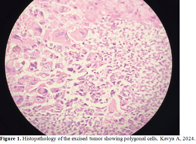 Hidradenocarcinoma: A Rare Skin Disease 2 figures
