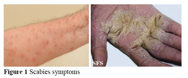 A Research on Formulation and Evaluation of Clove Gel for Treatment of Scabies 2 figures
