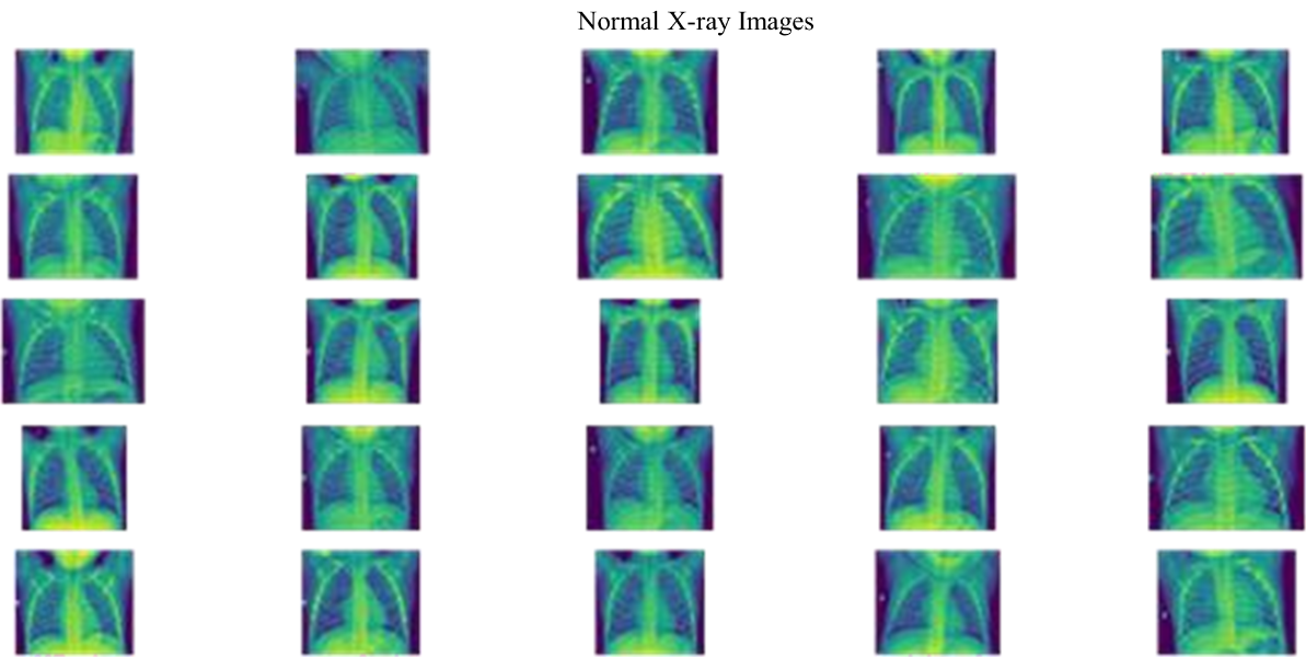 Detection of Pneumonia in COVID-19 Patients Using X-ray Images 4 figures