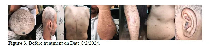 A Case Study on Ayurvedic Management of Psoriasis (Ekakushtha) 4 figures