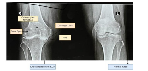 Revolutionizing Knee Osteoarthritis Diagnosis: Unleashing the Potential of Vision Transformers 2 figures