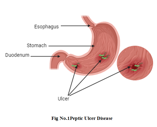 Enhancing Peptic Ulcer Therapy: Innovations in Mucoadhesive Drug Delivery 2 figures