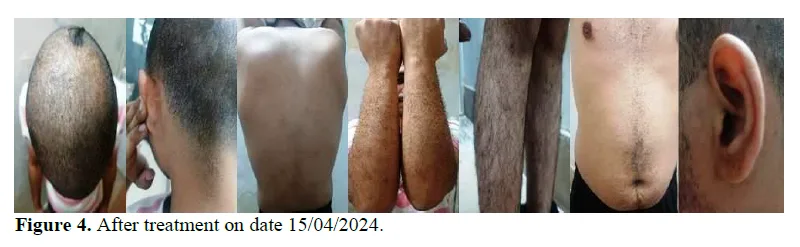 A Case Study on Ayurvedic Management of Psoriasis (Ekakushtha) 5 figures