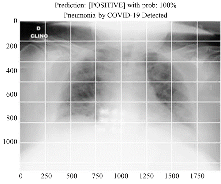 Detection of Pneumonia in COVID-19 Patients Using X-ray Images 9 figures