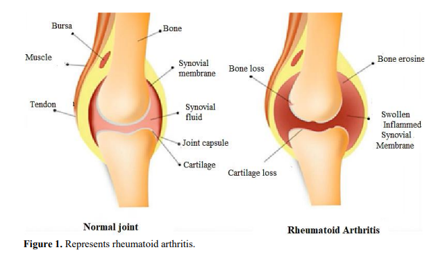 DMARDs, Biologic Agents and Novel Experimental Strategies in The Treatment of Rheumatoid Arthritis 2 figures