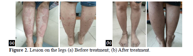 A Case Study on Ayurvedic Management of Psoriasis. 3 figures