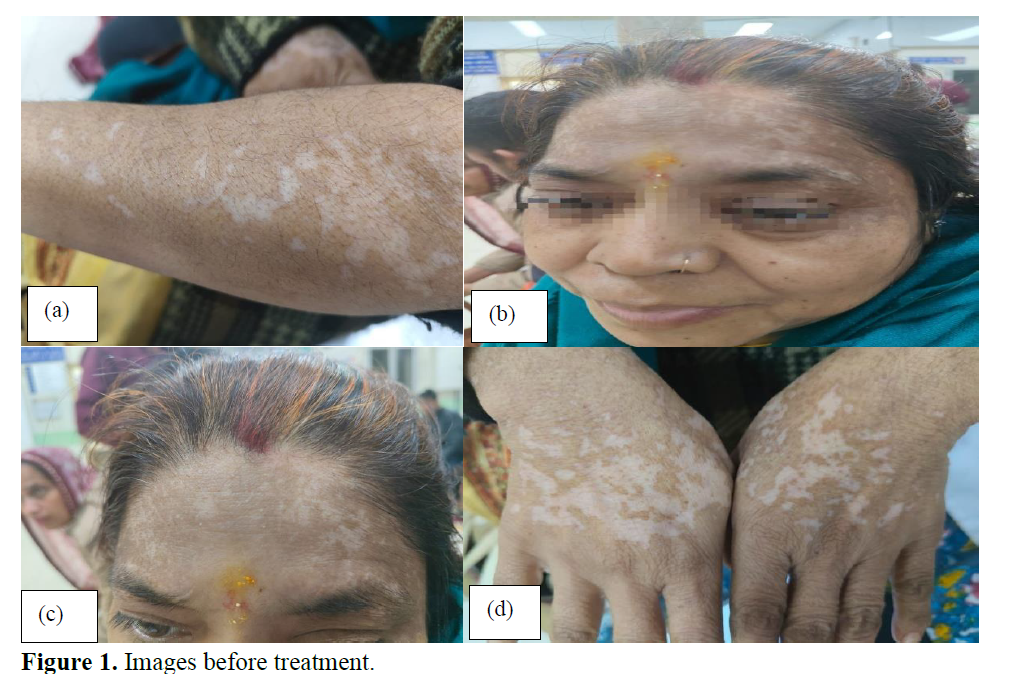 A Case Study on the Efficacy of Sanshamana Chikitsa in Vitiligo (Shwitra) 2 figures