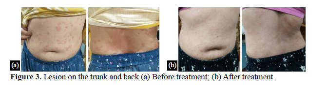 A Case Study on Ayurvedic Management of Psoriasis. 4 figures