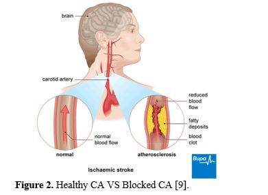 Revealing the Hemodynamic Orchestra: Contrasting Analysis of Blood Flow Patterns in a Bifurcated Carotid Artery 3 figures