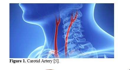 Revealing the Hemodynamic Orchestra: Contrasting Analysis of Blood Flow Patterns in a Bifurcated Carotid Artery 2 figures