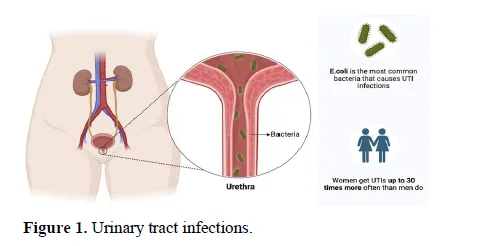 Strategies in the Battle against Recurrent UTIs: A Brief Overview 2 figures