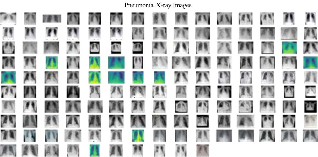 Detection of Pneumonia in COVID-19 Patients Using X-ray Images 5 figures