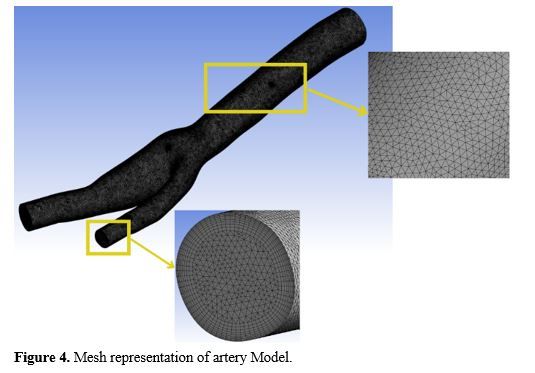 Revealing the Hemodynamic Orchestra: Contrasting Analysis of Blood Flow Patterns in a Bifurcated Carotid Artery 5 figures