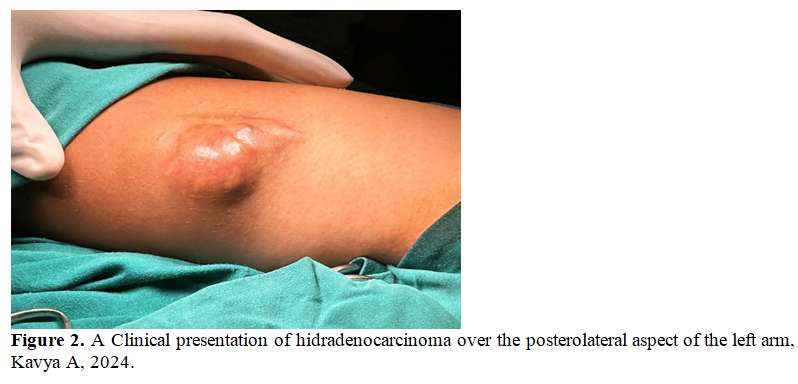 Hidradenocarcinoma: A Rare Skin Disease 3 figures