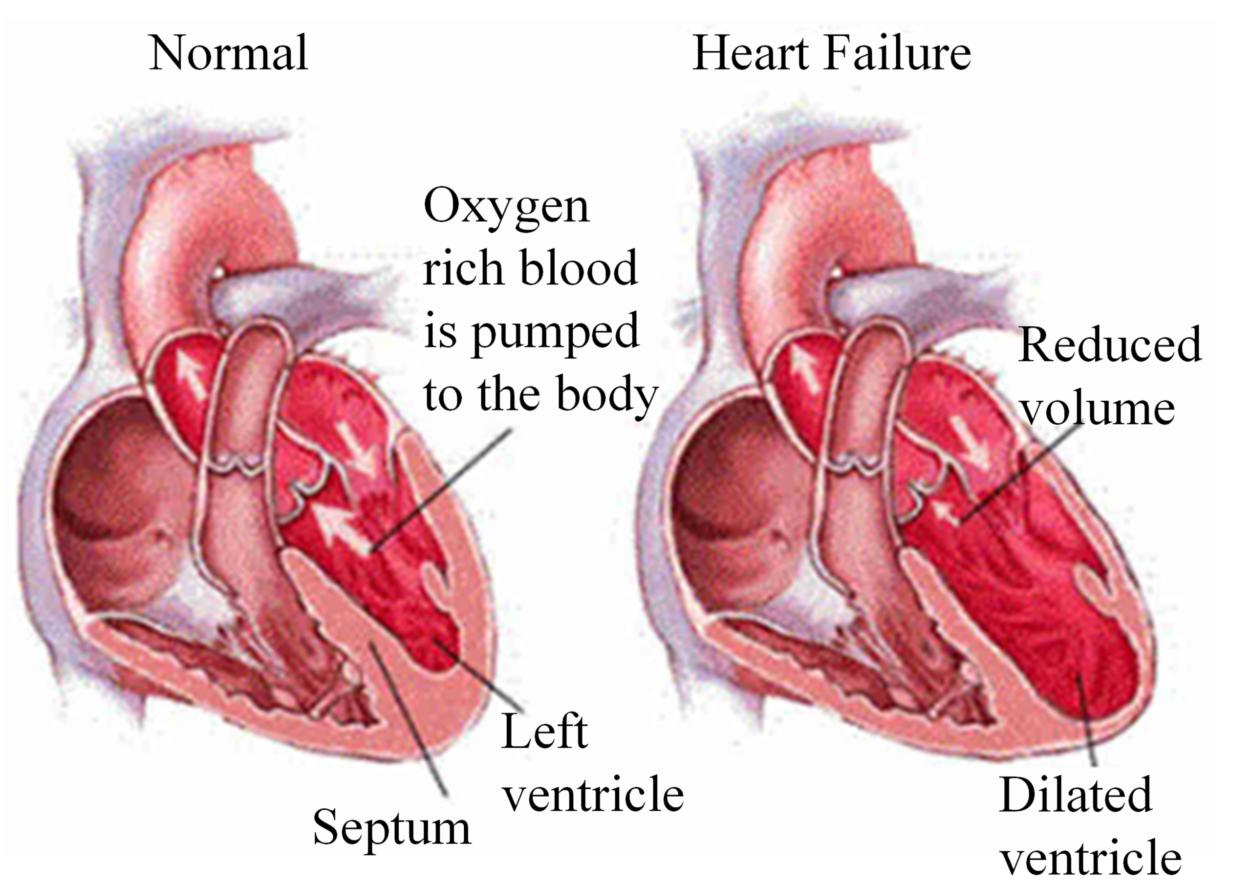 343823e0 heart failure scaled