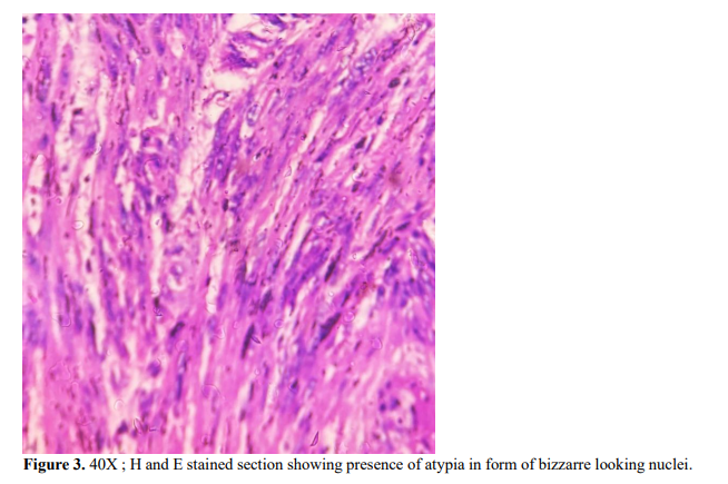 A Rare Case Of Symplastic Leiomyoma Of Uterus : A case Report 4 figures
