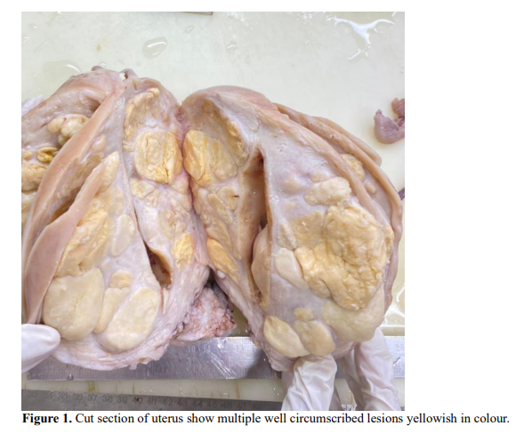 A Rare Case Of Symplastic Leiomyoma Of Uterus : A case Report 2 figures