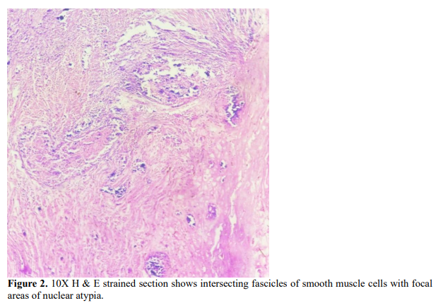 A Rare Case Of Symplastic Leiomyoma Of Uterus : A case Report 3 figures